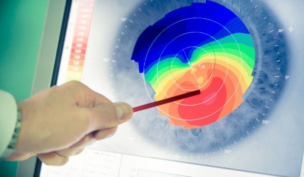 Topografia-de-Cornea